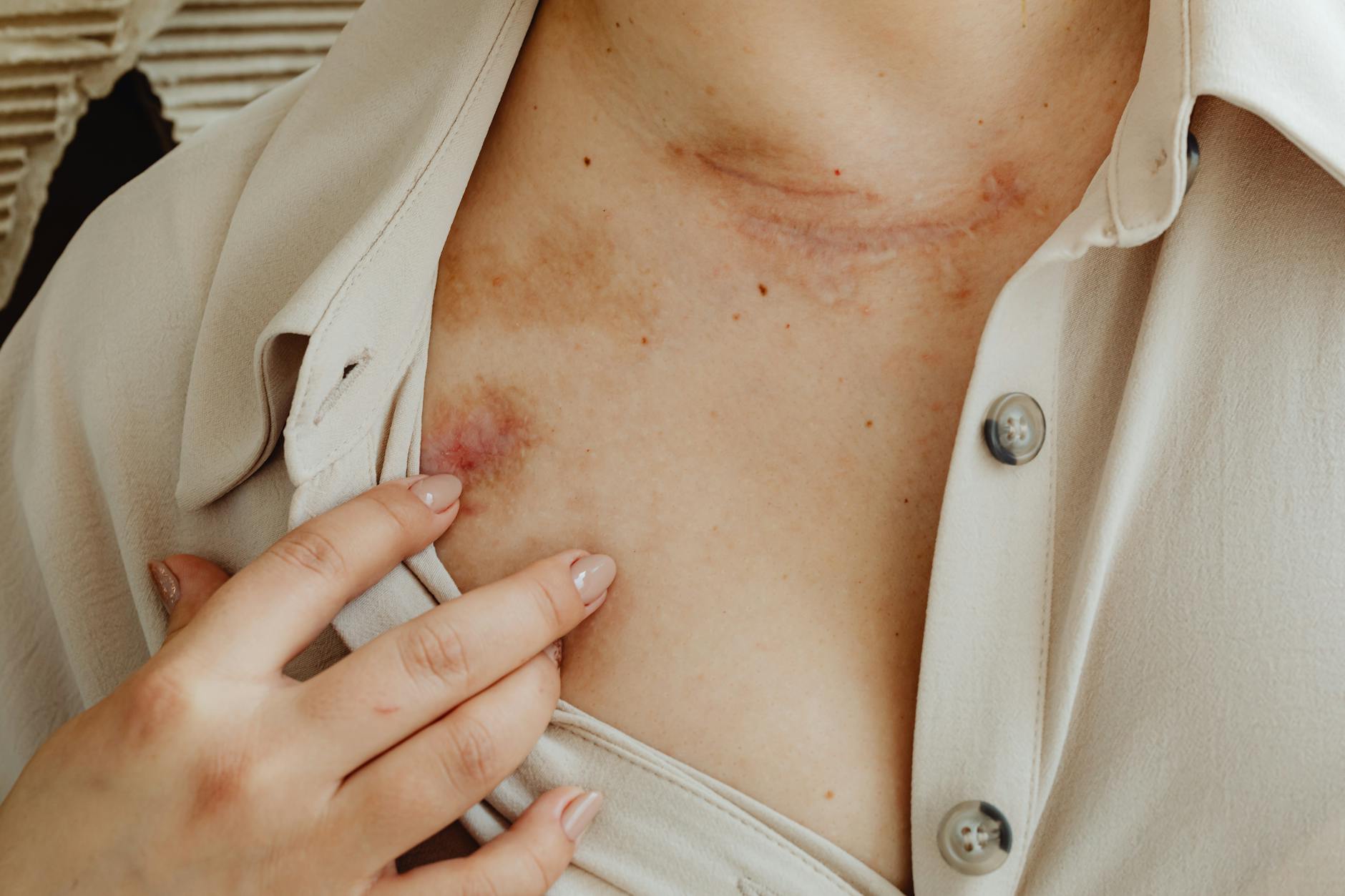 7 Conditions Commonly Mistaken for Hidradenitis Suppurativa